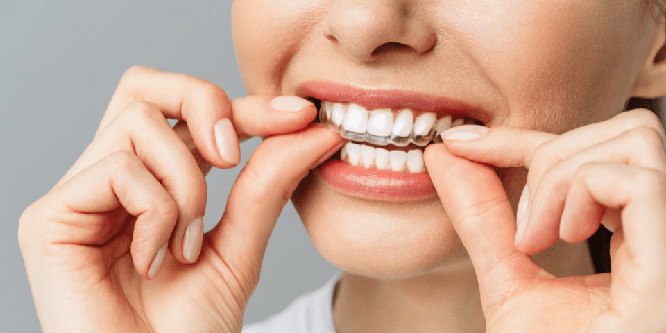 Teeth Aligner Dentist in Dhantoli