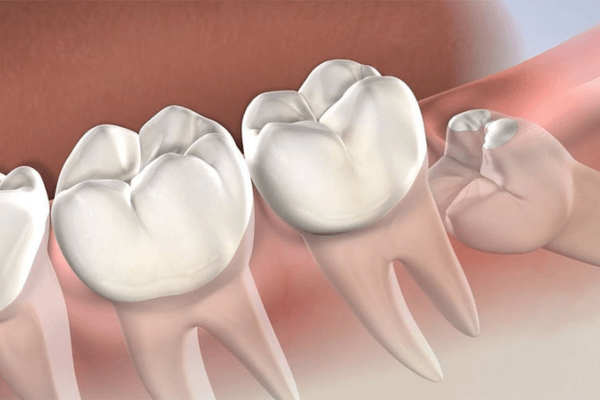 Wisdom Tooth Removal